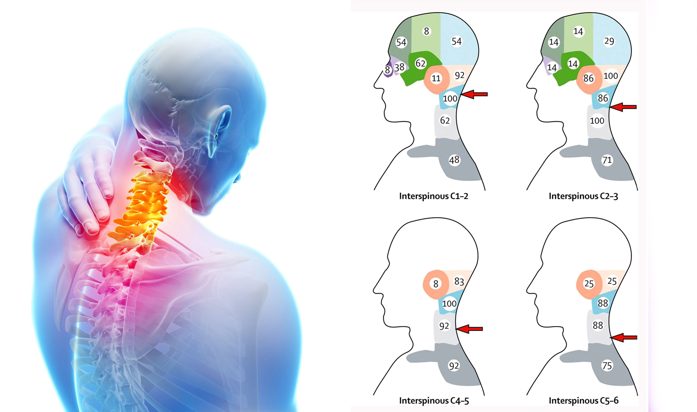Cervicogenic